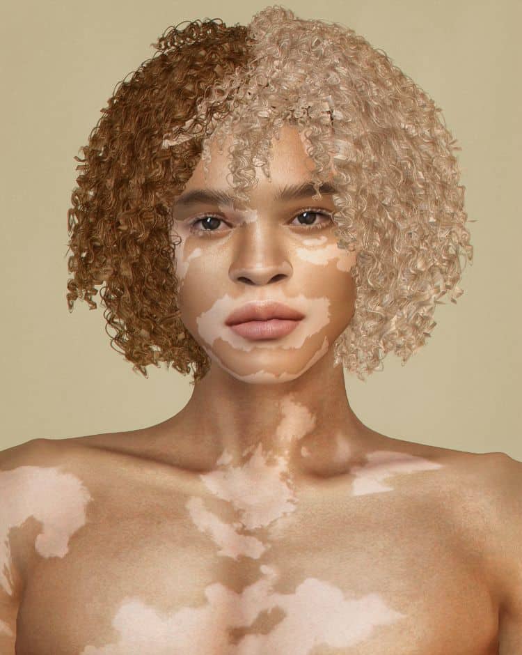 sim women with vitiligo