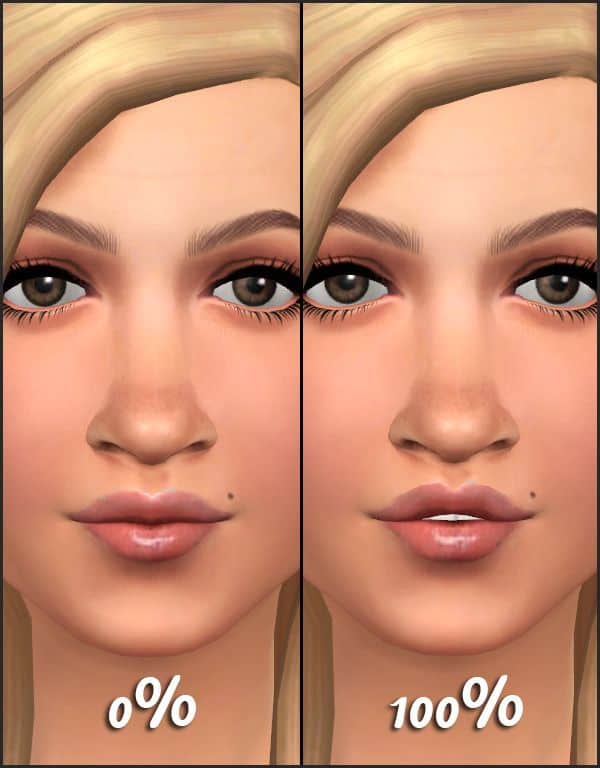 before and after upper lip height change