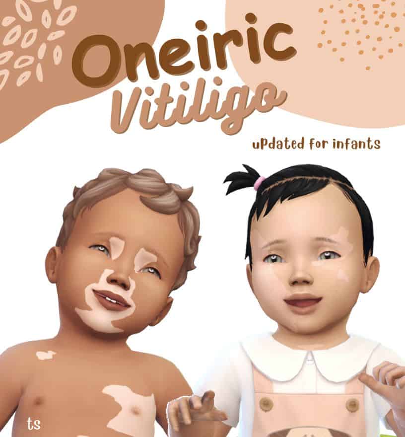 two infants with vitiligo