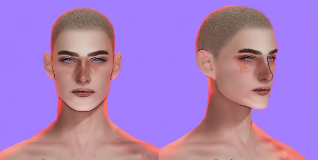 male sim with birthmarks across the nose and around the eye area