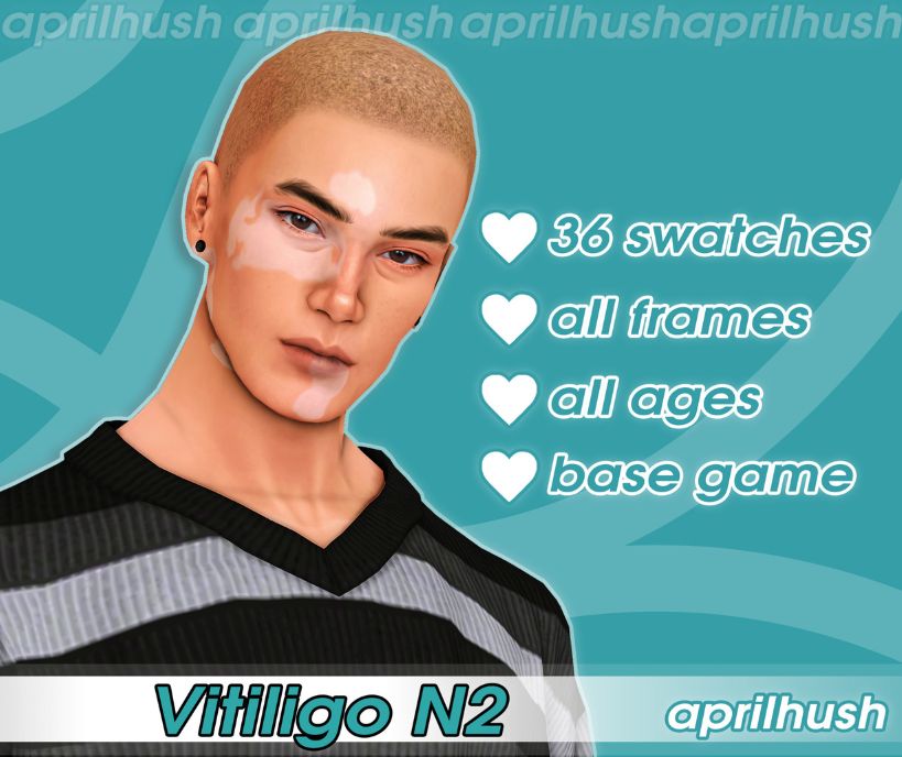 male Sim with patches of vitiligo on his face